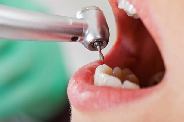 Best Emergency Treatment for Dental Infections or Abscesses in Columbus Grove, OH